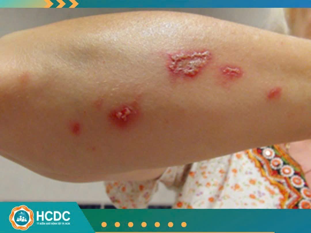 Cảnh báo dịch bệnh trẻ em mùa hè 2025: Ba mẹ cần làm gì để bảo vệ con?